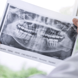 Radiographie dentaire
