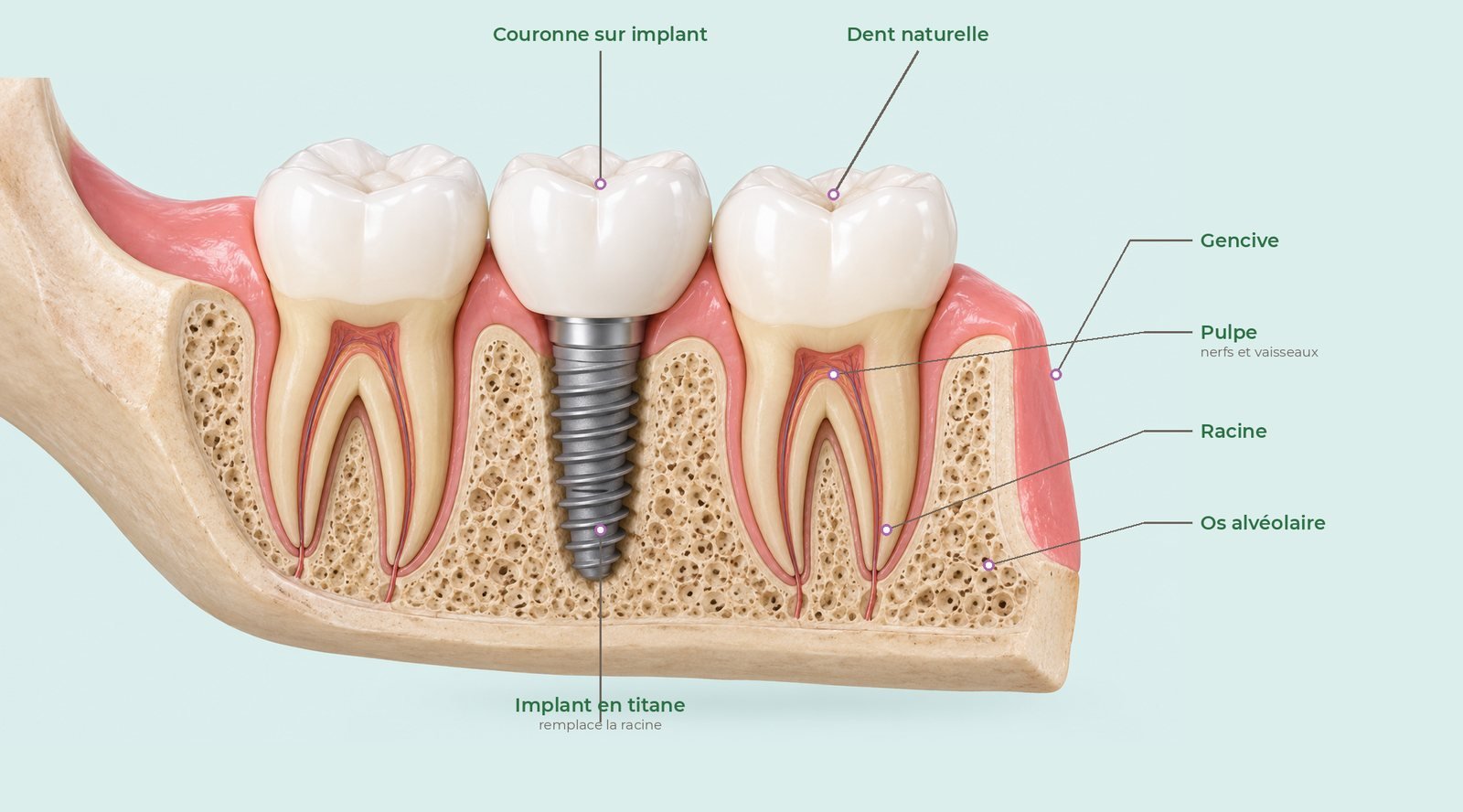 Coupe d’une mâchoire montrant une couronne sur implant entre deux dents naturelles, avec gencive, pulpe, racines et os alvéolaire