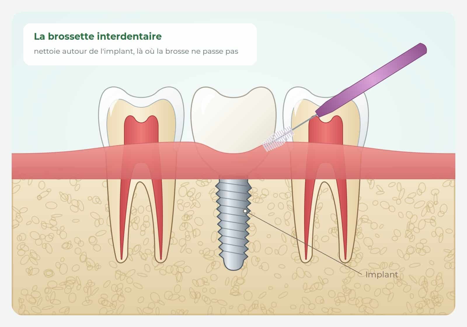 Brossette interdentaire nettoyant entre une couronne sur implant et une dent voisine