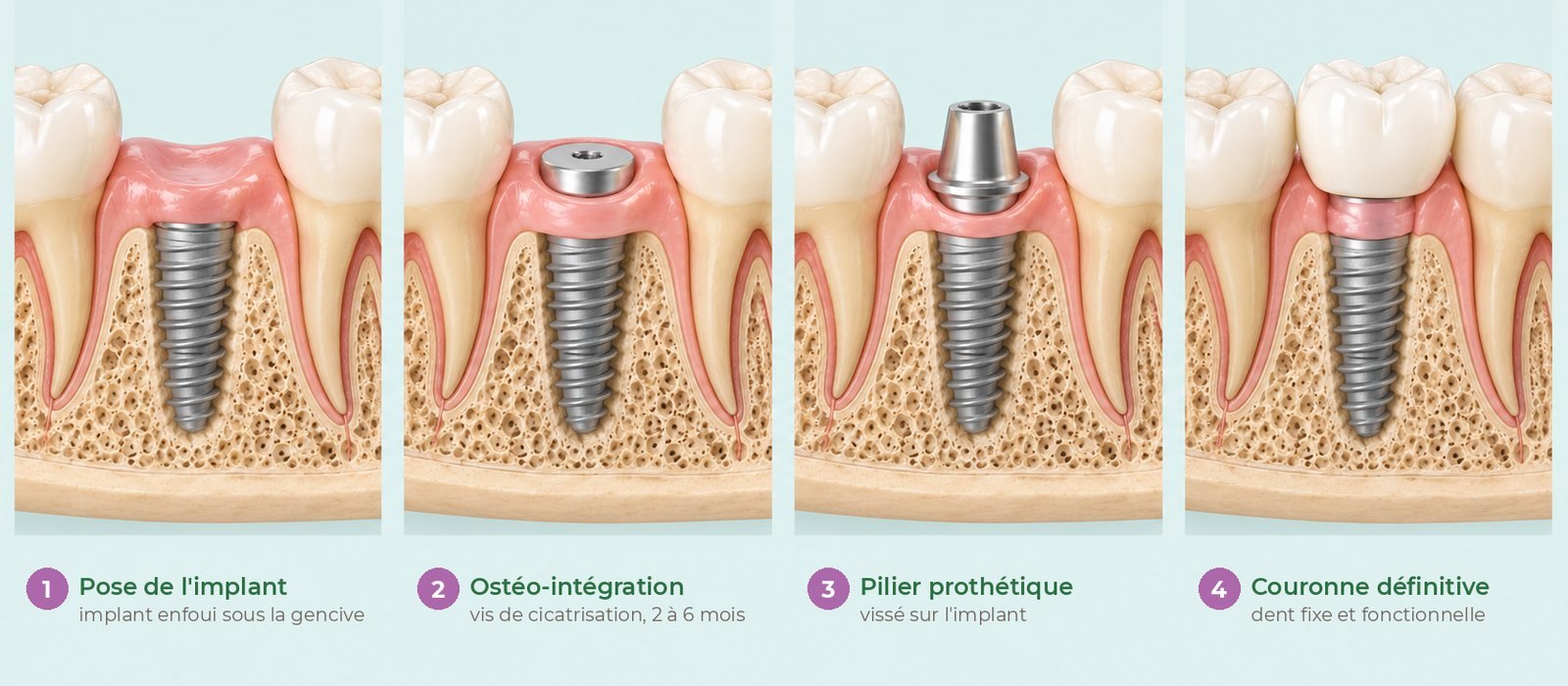 Les quatre étapes d’un implant : pose, ostéo-intégration, pilier, couronne définitive