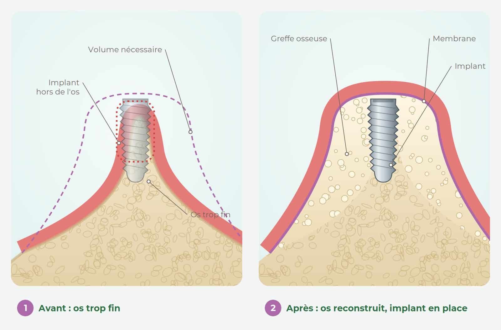 Coupe de la mâchoire avant et après greffe osseuse, avec membrane et implant en place