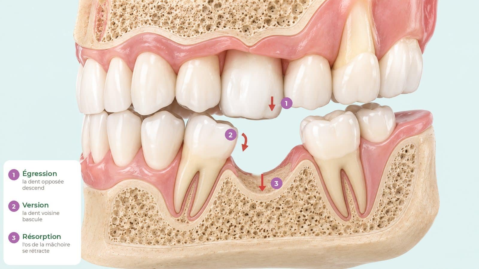 Conséquences d’une dent manquante : égression de la dent opposée, version de la dent voisine et résorption osseuse