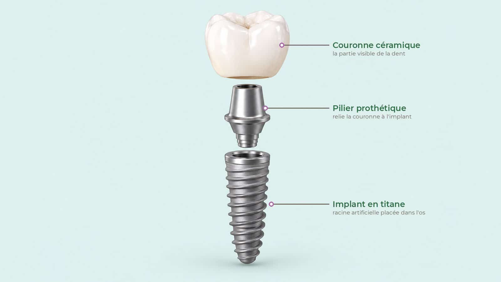 Vue éclatée d’une dent sur implant : couronne céramique, pilier et implant en titane